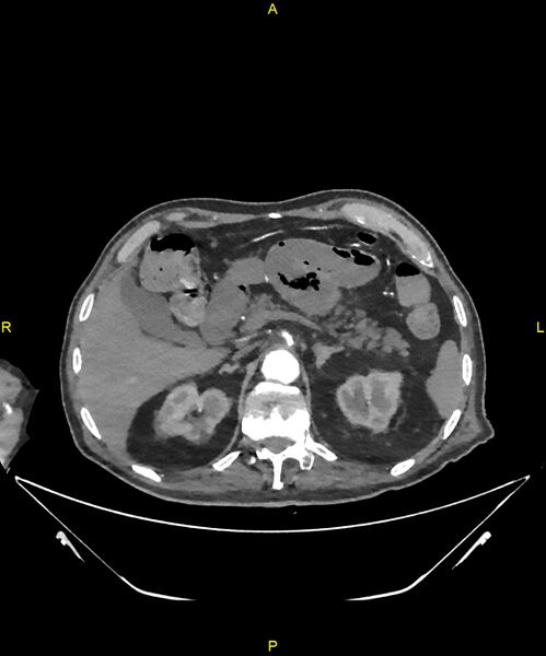 File:Aortoenteric fistula (Radiopaedia 84308-99603 B 84).jpg