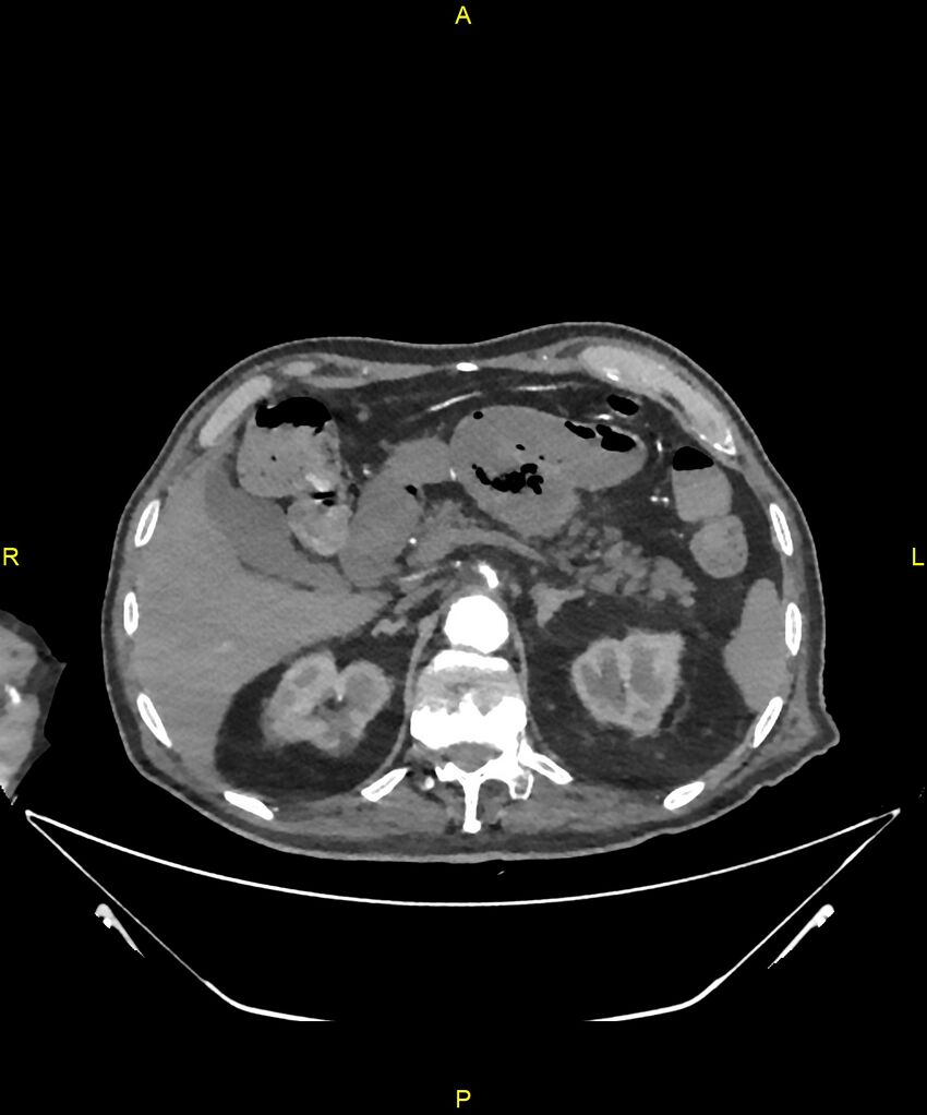 Aortoenteric fistula (Radiopaedia 84308-99603 B 84).jpg