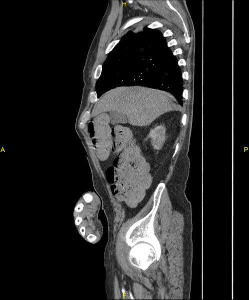 File:Aortoenteric fistula (Radiopaedia 84308-99603 C 74).jpg