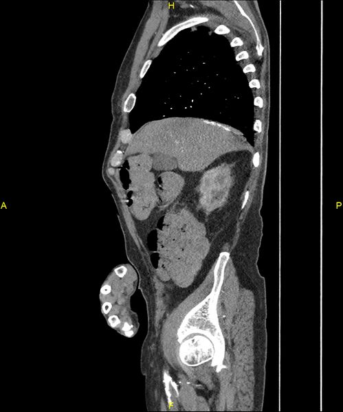 File:Aortoenteric fistula (Radiopaedia 84308-99603 C 81).jpg
