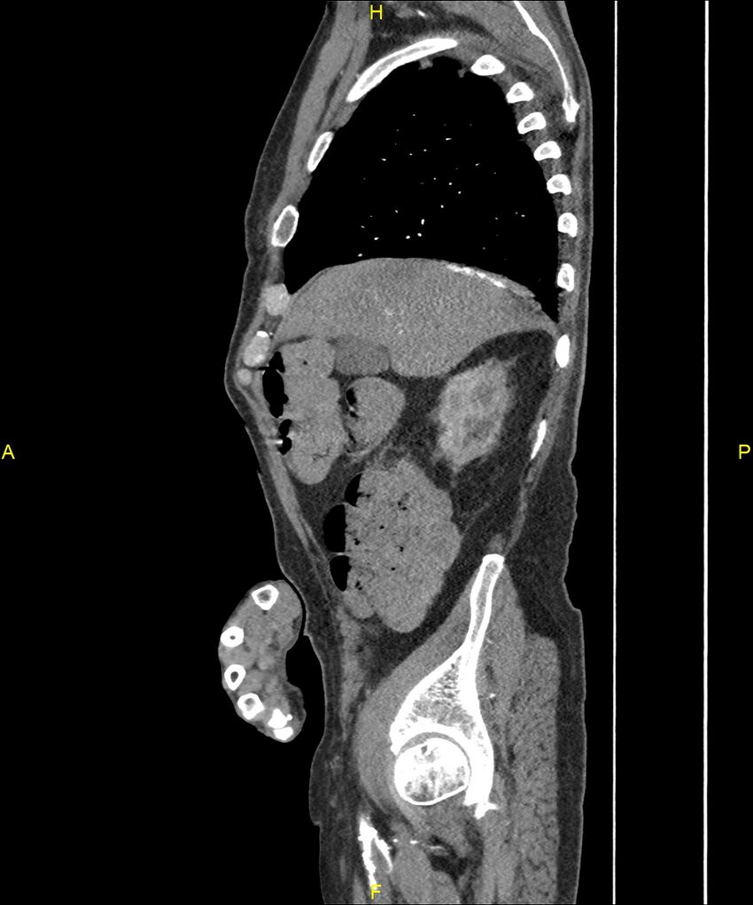 Aortoenteric fistula (Radiopaedia 84308-99603 C 81).jpg