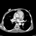 Aortopulmonary window, interrupted aortic arch and large PDA giving the descending aorta (Radiopaedia 35573-37074 B 43).jpg