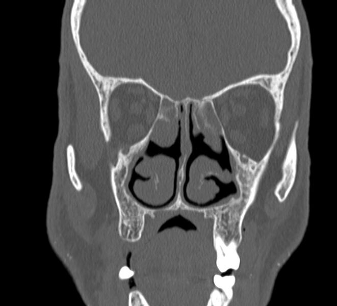 File:Aplastic maxillary sinuses (Radiopaedia 60030-67561 Coronal non-contrast 19).jpg