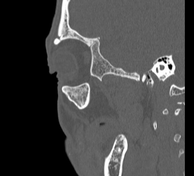 File:Aplastic maxillary sinuses (Radiopaedia 60030-67561 Sagittal bone window 2).jpg