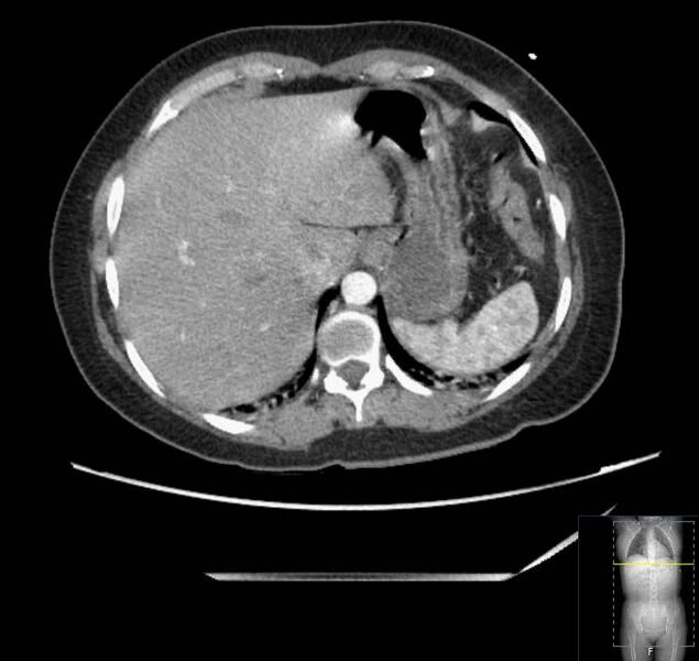 File:Appendicitis (CT angiogram) (Radiopaedia 154713-127660 Axial 164).jpg