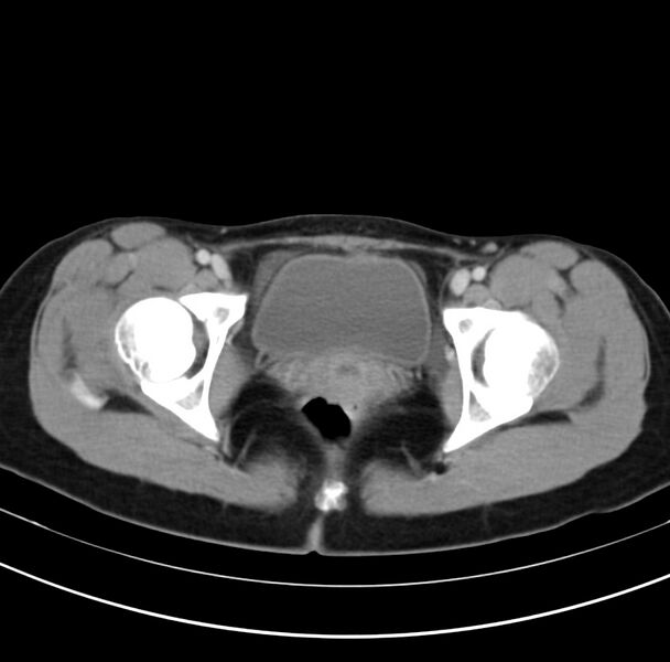 File:Appendicitis and incidental bicornuate uterus (Radiopaedia 22833-22853 B 44).jpg