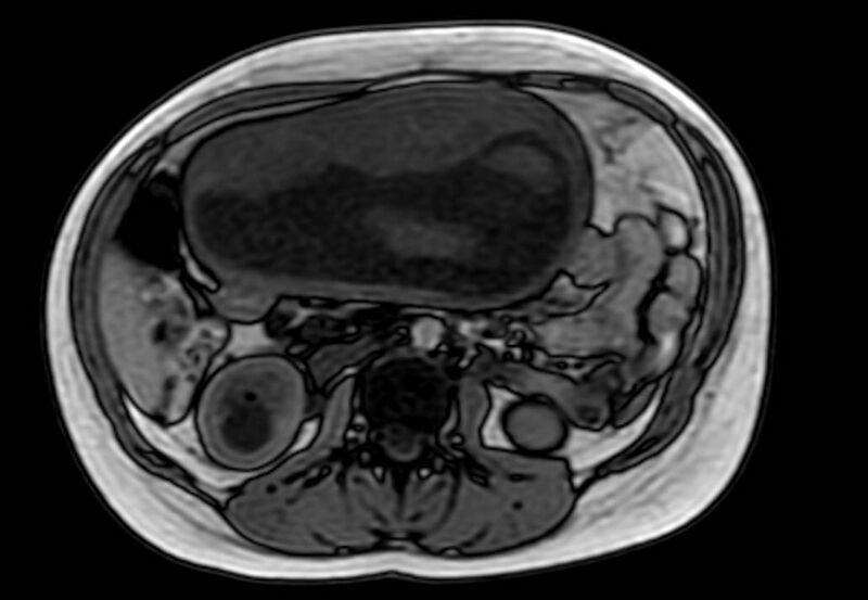 File:Appendicitis in gravida (MRI) (Radiopaedia 89433-106395 D 29).jpg