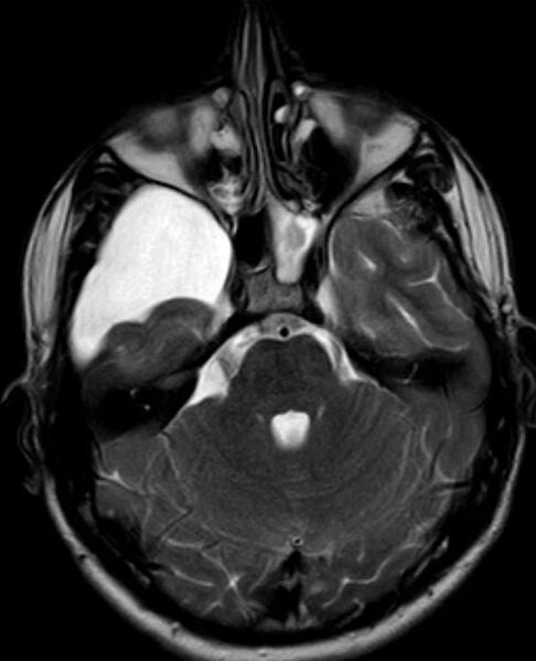 File:Arachnoid cyst- extremely large (Radiopaedia 68741-78451 Axial T2 8).jpg