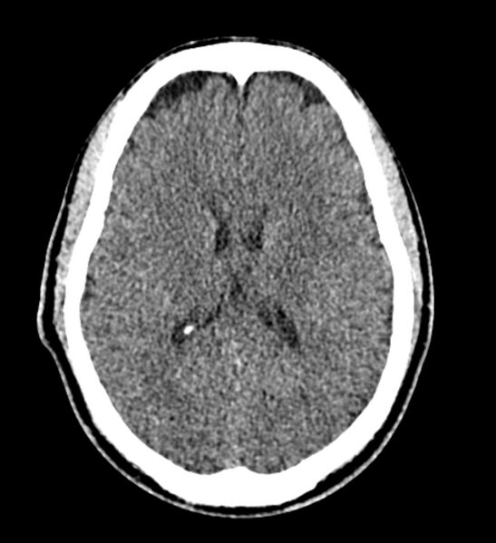 File:Arachnoid cyst of the ambient cistern (Radiopaedia 81301-94986 Axial non-contrast 42).jpg