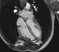 Arrhythmogenic right ventricular cardiomyopathy (Radiopaedia 39806-42237 D 43).jpg