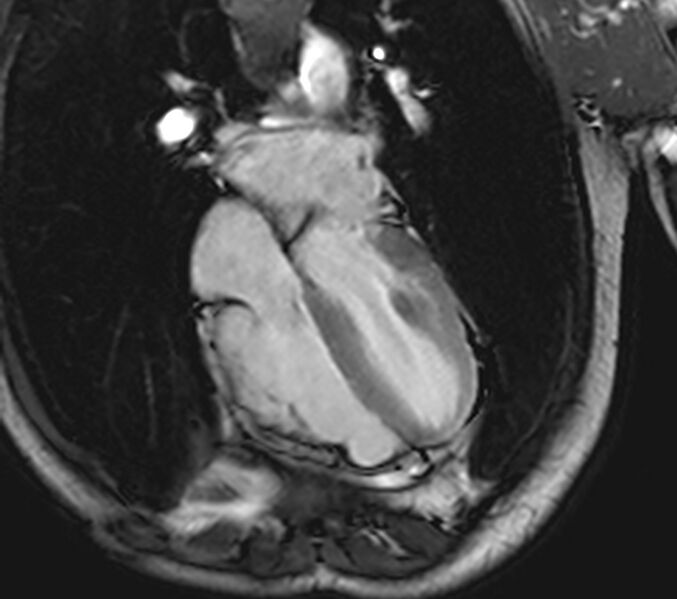 File:Arrhythmogenic right ventricular cardiomyopathy (Radiopaedia 39806-42237 D 43).jpg