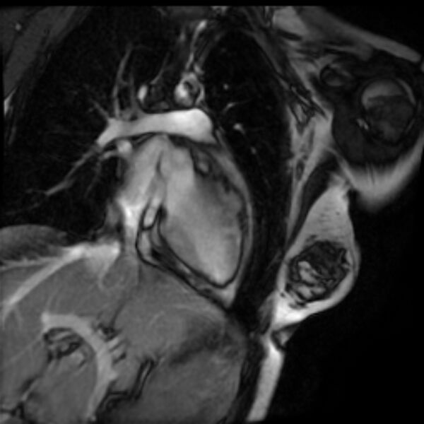 File:Arrhythmogenic right ventricular cardiomyopathy (Radiopaedia 87505-103850 2ch (LV) Cine SSFP 10).jpg