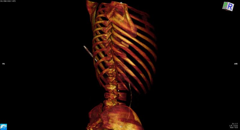 File:Arrow injury to the chest (Radiopaedia 75223-86321 3D bone 29).jpg