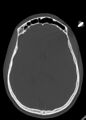 Arrow injury to the head (Radiopaedia 75266-86388 Axial bone window 77).jpg