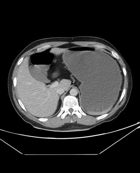 File:Arterial occlusive mesenteric ischemia (Radiopaedia 84641-100054 A 26).jpg