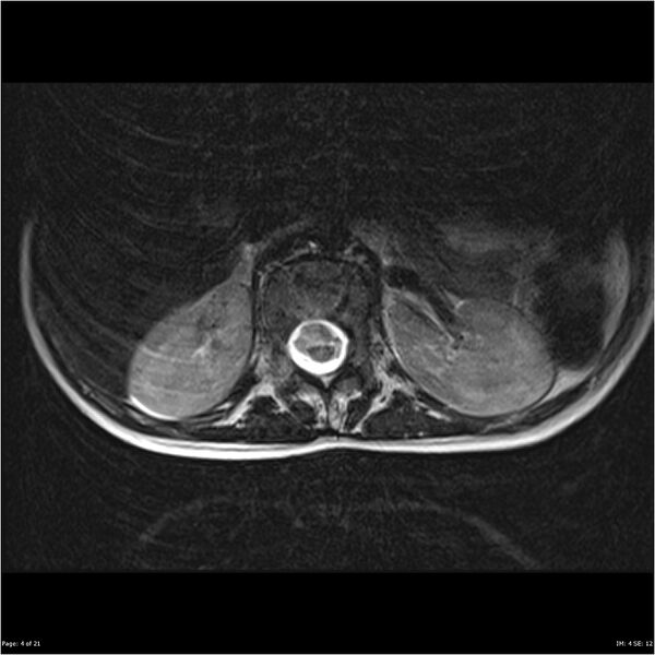 File:Arthrogryposis and muscle atrophy (Radiopaedia 24081-24314 D 4).jpg