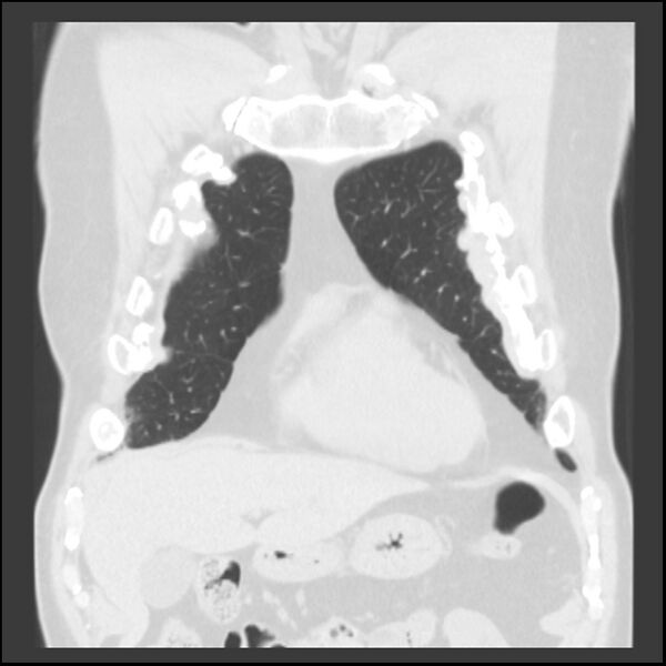 File:Asbestos-related pleural plaques (Radiopaedia 39069-41255 Coronal lung window 72).jpg