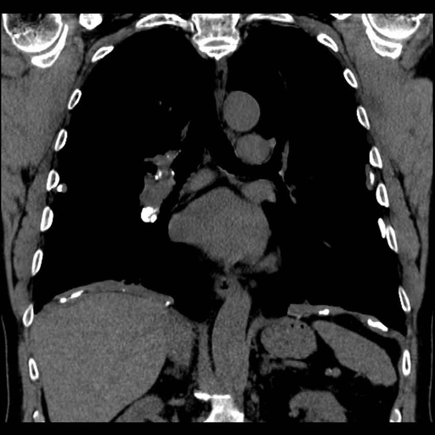 Asbestos-related pleural plaques (Radiopaedia 39069-41255 Coronal non-contrast 39).jpg