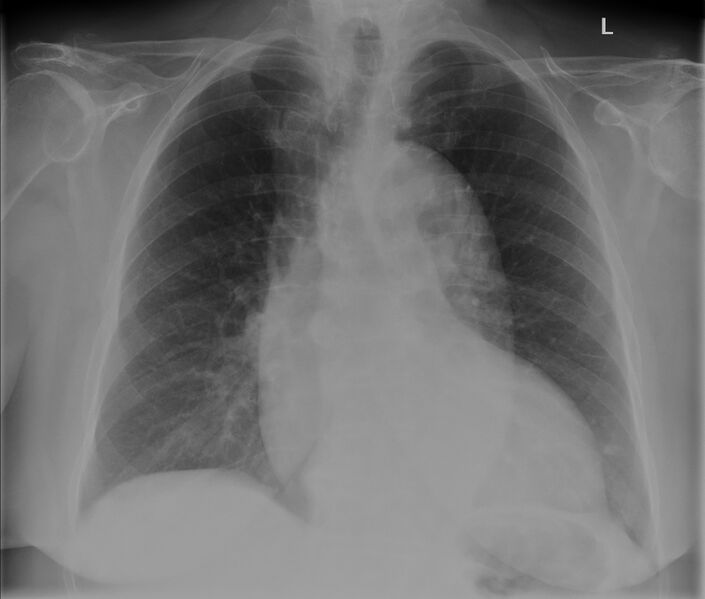 File:Ascending aortic aneurysm (Radiopaedia 20913-20845 Frontal 1).jpg