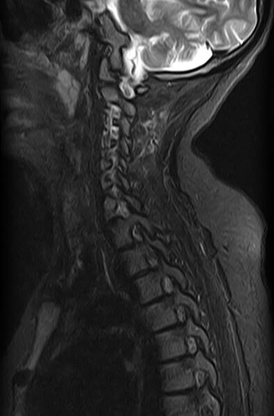 File:Astrocytoma - spinal cord (Radiopaedia 69769-79758 Sagittal STIR 9).jpg