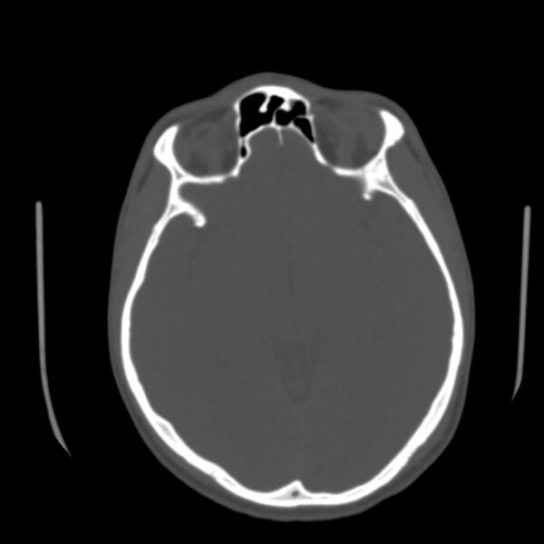 File:Asymptomatic occipital spur (Radiopaedia 87753-104201 Axial bone window 84).jpg