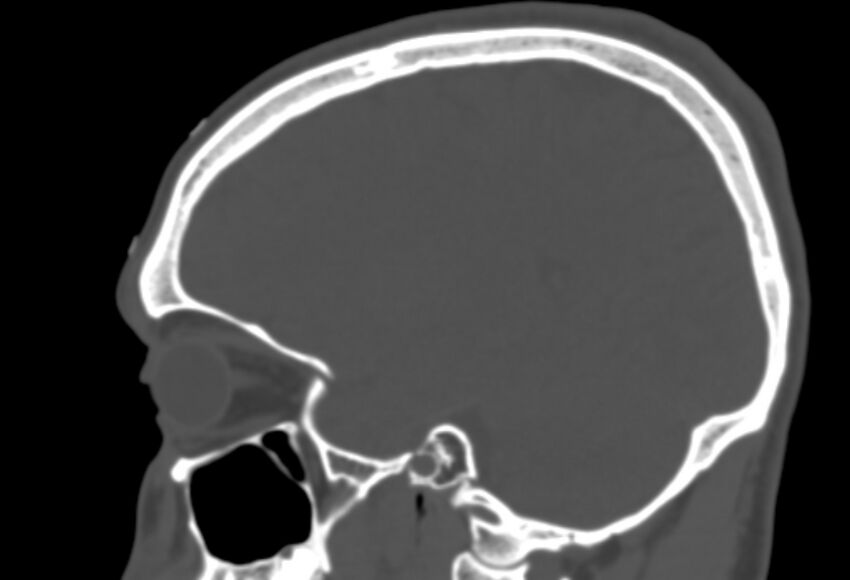 Asymptomatic occipital spur (Radiopaedia 87753-104201 Sagittal bone window 204).jpg