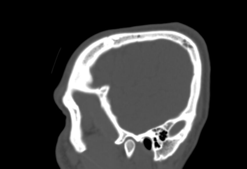 Asymptomatic occipital spur (Radiopaedia 87753-104201 Sagittal bone window 31).jpg