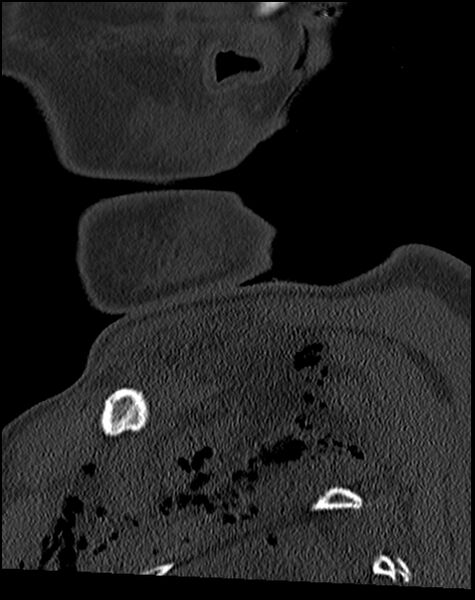 File:Atlanto-occipital dissociation - Traynelis type 1 (Radiopaedia 87570-103948 Sagittal bone window 10).jpg