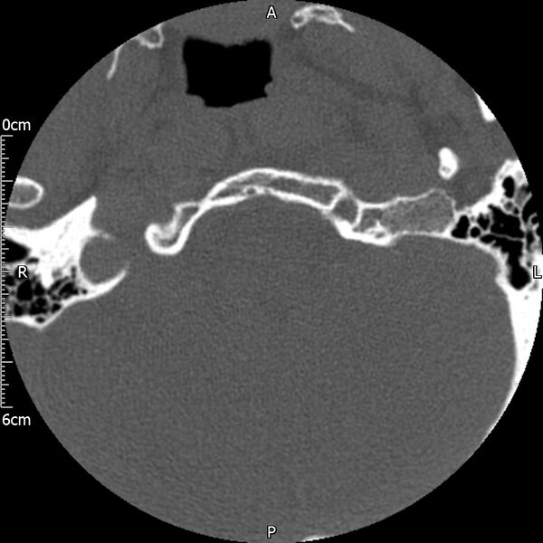 File:Atlas fracture with Currarino type A congenital defect (Radiopaedia 71747-82144 Axial bone window 2).jpg