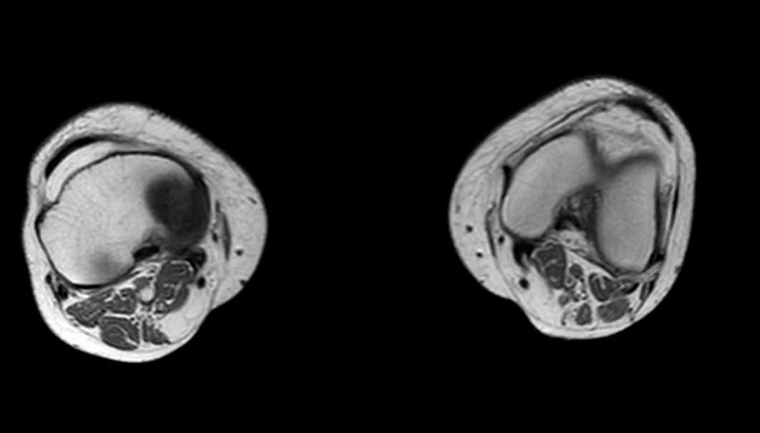 Atypical lipomatous tumor - thigh (Radiopaedia 68975-78734 Axial T1 5).jpg