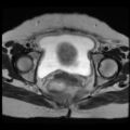Atypical retroperitoneal lymphocoeles with large leiomyoma of uterus (Radiopaedia 32084-33027 Axial T2 25).jpg