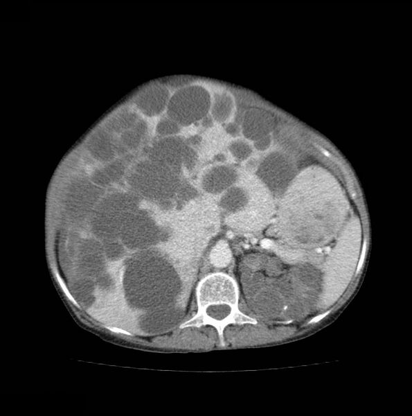 File:Autosomal dominant polycystic kidney disease (Radiopaedia 16777-16490 A 20).jpg