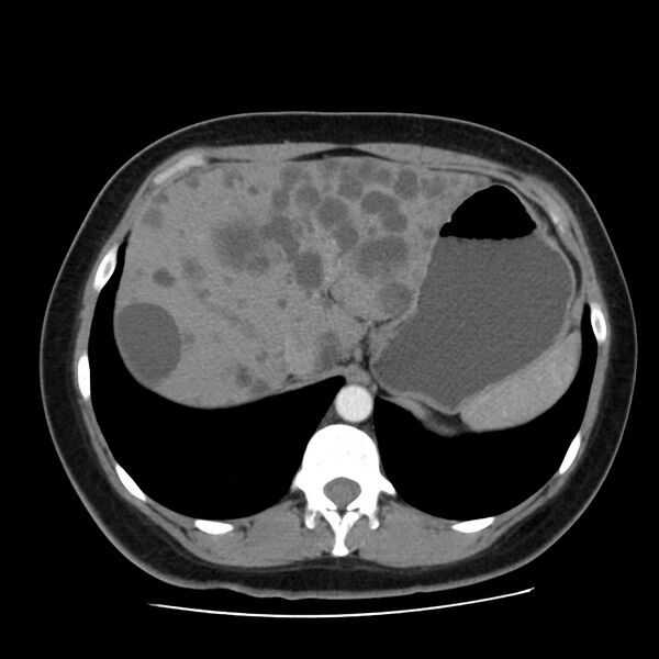 File:Autosomal dominant polycystic kidney disease (Radiopaedia 23061-23093 B 14).jpg