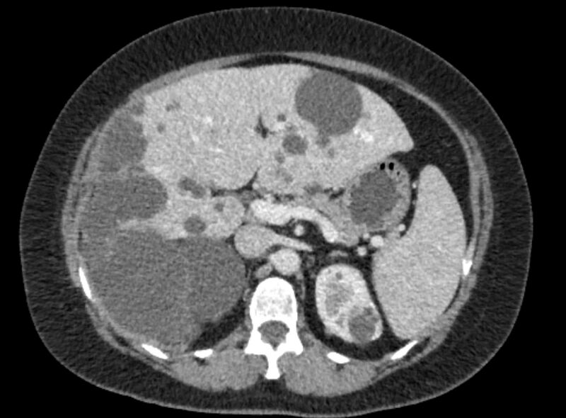 File:Autosomal dominant polycystic kidney disease (Radiopaedia 57124-64017 A 42).jpg