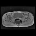 Avascular necrosis of the hip (Radiopaedia 29563-30067 Axial T1 fat sat 5).jpg