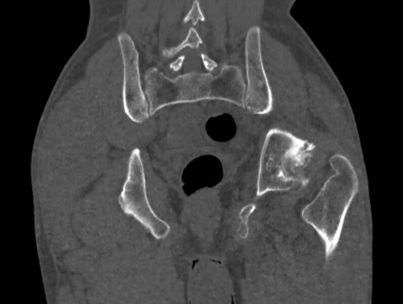 File:Avascular necrosis of the left hip (Radiopaedia 75068-86125 Coronal bone window 72).jpg