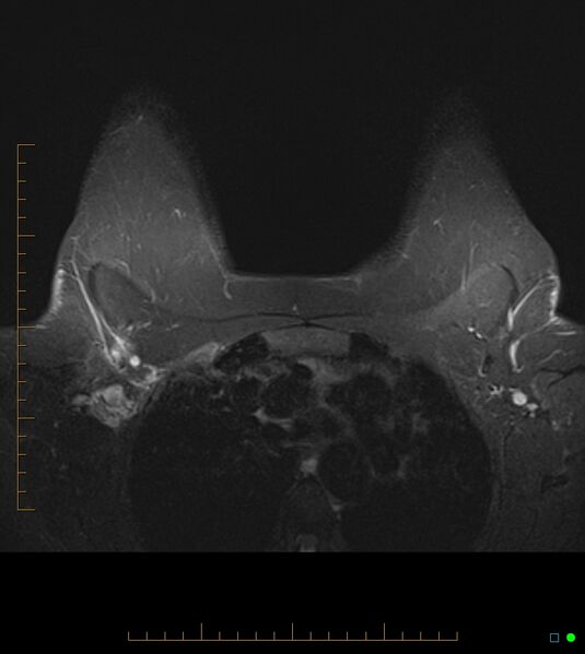 File:Axillary lymphadenopathy on breast MRI- yellow fever vaccination induced (Radiopaedia 19454-19483 Axial T2 fat sat 5).jpg