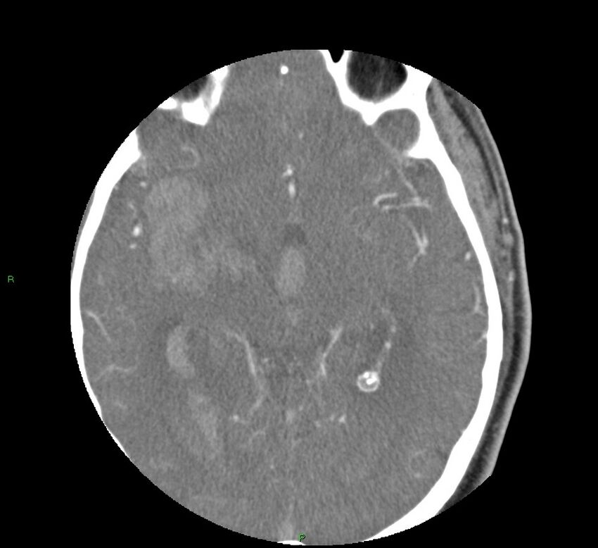 Basal ganglia hemorrhage (Radiopaedia 58763-65985 D 87).jpg
