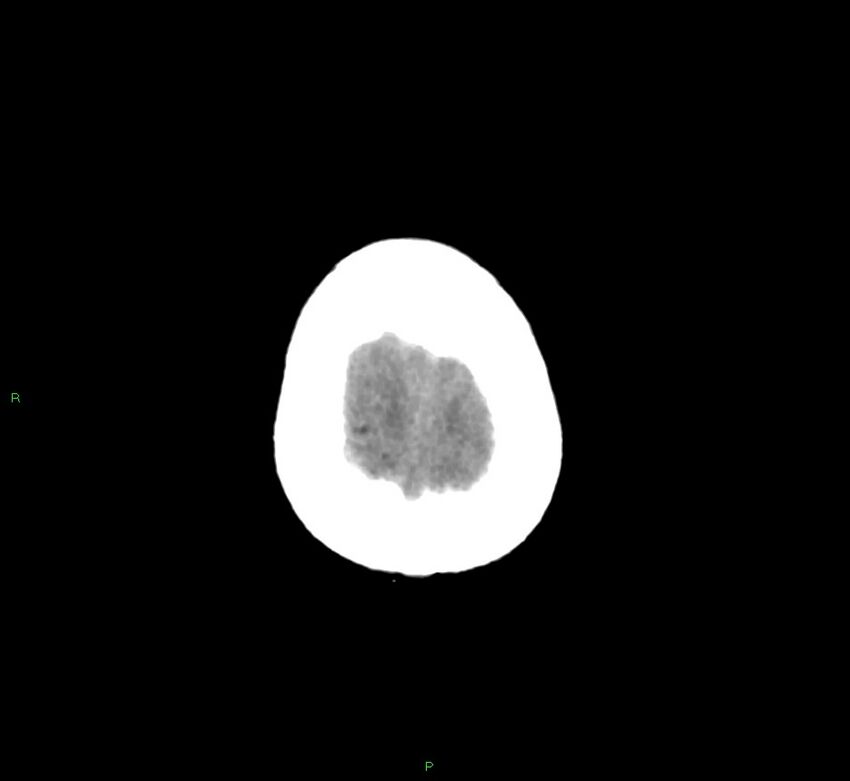 Basal ganglia hemorrhage (Radiopaedia 58775-66008 Axial non-contrast 10).jpg