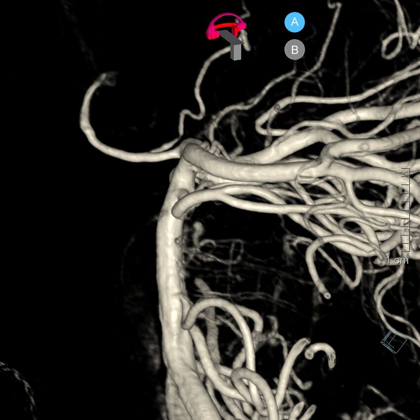 Basilar artery perforator aneurysm (Radiopaedia 82455-97734 3D view left VA 94).jpg