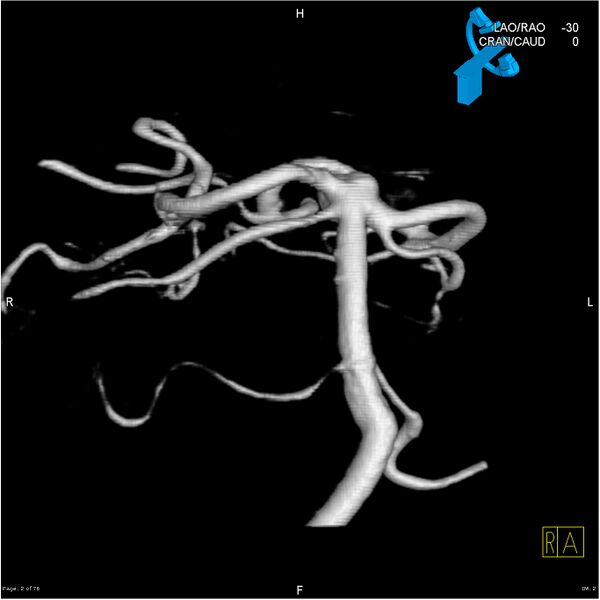 File:Basilar tip aneurysm double balloon remodeling (Radiopaedia 18100-17883 3D rotation 2).jpg