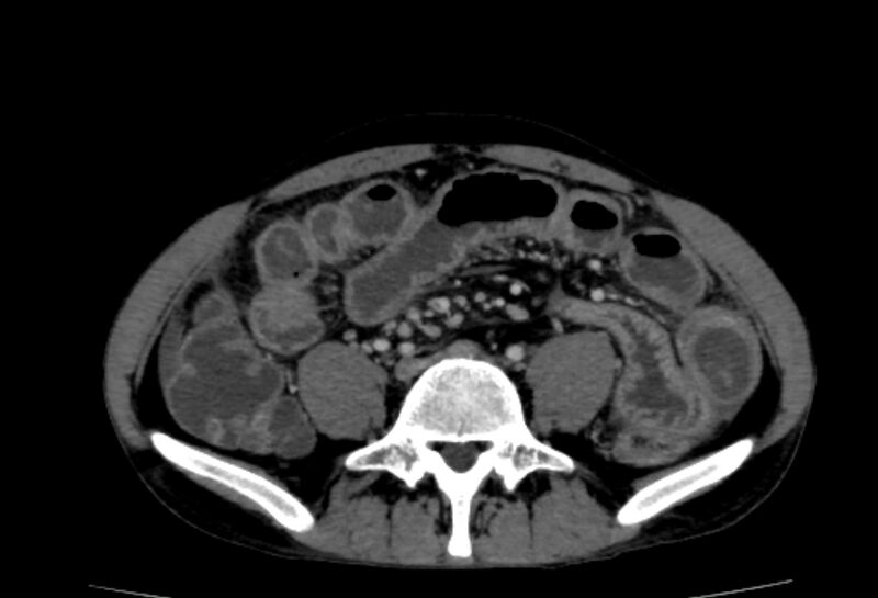 File:Behçet's disease- abdominal vasculitis (Radiopaedia 55955-62570 A 55).jpg