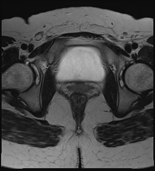 File:Bicornuate, unicollis uterus (Radiopaedia 79468-92593 Axial T2 20).jpg