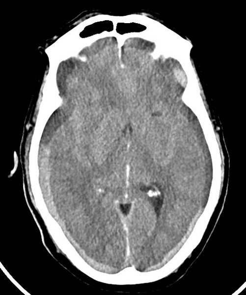 File:Bilateral acute on chronic subdural hematomas (Radiopaedia 78466-91146 Axial non-contrast 28).jpg