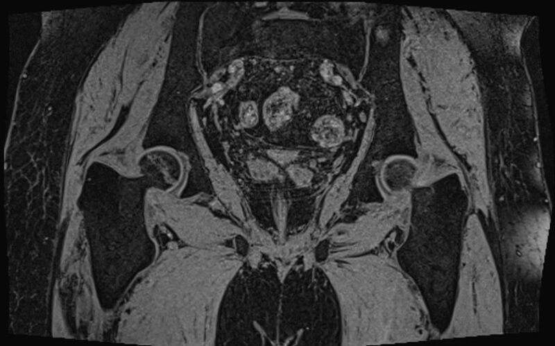 File:Bilateral avascular necrosis of femoral head (Radiopaedia 77116-89078 Coronal T2 we 19).jpg