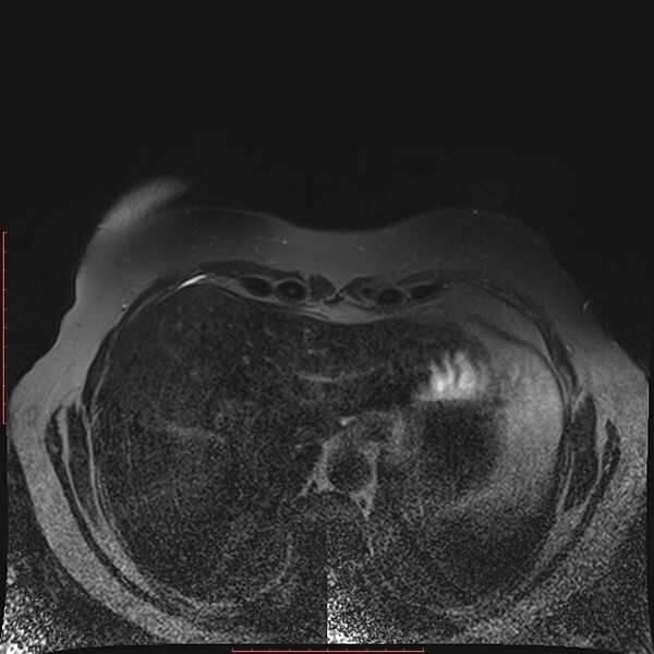 File:Bilateral breast implant rupture (Radiopaedia 24761-25027 T2 fat sat 35).jpg