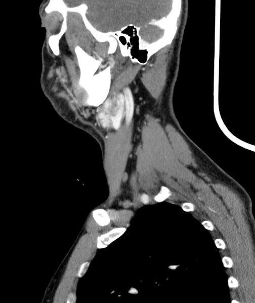 File:Bilateral carotid body tumors (Radiopaedia 52899-58827 C 4).jpg