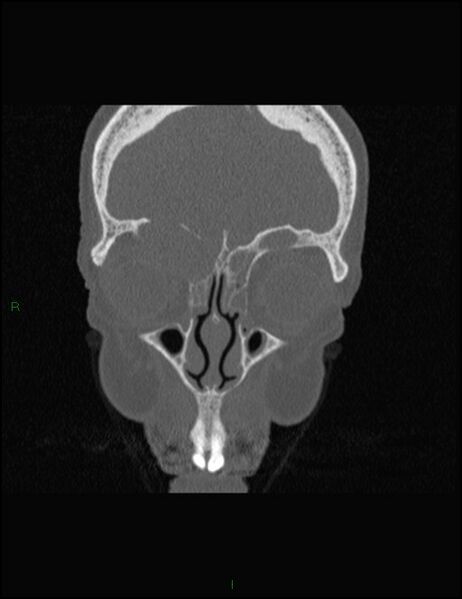 File:Bilateral frontal mucoceles (Radiopaedia 82352-96454 Coronal 94).jpg