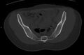 Bilateral mature cystic ovarian teratoma (Radiopaedia 88821-105592 Axial bone window 4).jpg
