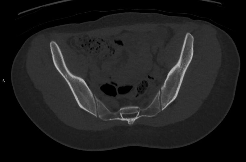 File:Bilateral mature cystic ovarian teratoma (Radiopaedia 88821-105592 Axial bone window 4).jpg